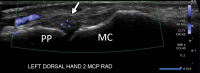 Inflammatory arthritis in a 43-year-old man who had recovered from
mild COVID-19 a few weeks earlier and presented with scattered areas of
bilateral hand arthralgia and periarticular swelling. The left second
metacarpophalangeal (MCP) joint was among the affected joints. Long-axis
microvascular Doppler US image of the radial margin of the second MCP joint
shows a mildly thickened synovial fluid complex with mild hyperemia (arrow),
indicating active synovitis. No articular erosions were seen, and no
significant periarticular vascularity was seen at color Doppler US of the
same region. MC = metacarpal (head), PP = proximal phalanx.