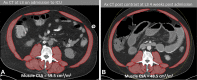 Sarcopenia in a 54-year-old man hospitalized for COVID-19 acute
respiratory distress syndrome who was diagnosed with weakness and global
pelvic muscle atrophy. (A) Axial CT image of the abdomen at the L3 level was
obtained at patient admission, and subsequent skeletal muscle
cross-sectional area quantification measured 59.5 cm2/m2. (B) Repeat axial
CT image of the abdomen at the L3 level 4 weeks later, after an extended
stay in the intensive care unit, shows that the skeletal muscle
cross-sectional area has decreased to 48.5 cm2/m2, indicating
sarcopenia.