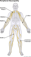 Diagram shows the most frequently reported sites of peripheral
neuropathy in patients with COVID-19. The upper extremity, particularly the
ulnar nerve and brachial plexus, is more commonly affected than the lower
extremity.