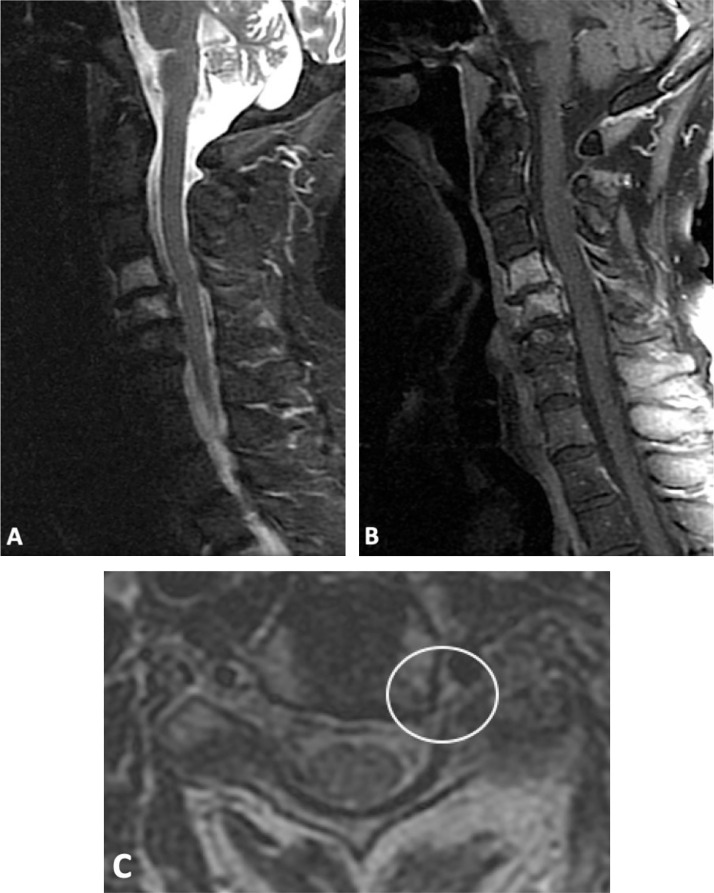 Bow Hunter's Syndrome: A rare cause of vertebrobasilar insufficiency - PMC