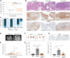 Figure 4. Pkm2 deletion slows progression of Pten-null prostate cancer. A, Kaplan–Meier curve assessing the onset of abnormal prostate growth as determined by serial MRI in Ptenpc–/– and Pkm2;Ptenpc–/– mice. The difference in time to abnormal prostate growth is significant. Median progression-free survival (MPFS) and HR for radiographic progression with 95% CI were determined by Mantel–Haenszel test with Ptenpc–/– as comparator group. B, Representative H&E and IHC assessment of PKM1 and PKM2 expression in prostate tissue harvested from Pkm2;Ptenpc–/– mice of the indicated age. Scale bar = 200 μm. C, Quantitation of PKM1 and PKM2 expression in prostate tissue harvested from Pkm2;Ptenpc–/– mice of the indicated age as determined by IHC. Tissue from 3 to 6 mice per age group was quantified. D, Representative MRI image of 6-month-old Ptenpc–/– and Pkm2;Ptenpc–/– mice. The left and right anterior prostates are outlined in each image. E, Prostate tumor volume estimated from serial MRI scans over time for a cohort of Ptenpc–/– and Pkm2;Ptenpc–/– mice as shown. Each line represents data from a single mouse, with the age of each mouse corresponding to time on the x-axis. F, Representative macroscopic images of anterior prostate tissue dissected from Ptenpc–/– or Pkm2;Ptenpc–/– mice as indicated. The age of the mouse in months at the time tissue was harvested is shown below each specimen. Scale bar = 1 cm. G, Weight of anterior prostate tissue dissected from 6-month-old WT and Ptenpc–/– mice, and 14- to 15-month-old Pkm2;Ptenpc–/– mice. Mean ± SD is shown (WT, n = 6; Ptenpc–/–, n = 4; and Pkm2;Ptenpc–/–, n = 4). The indicated differences in tissue weight are significant (**, P < 0.01 or ***, P < 0.001 by Student t test). H, Representative Ki-67 IHC of anterior prostate tissue harvested from 6-month-old WT, Ptenpc–/– and Pkm2;Ptenpc–/– mice. Scale bar = 200 μm. I, Proliferative index of anterior prostate tissue harvested from 6-month-old WT, Ptenpc–/– and Pkm2;Ptenpc–/– mice as determined by Ki-67 IHC. Mean ± the SD is shown (WT, n = 4; Ptenpc–/–, n = 3; and Pkm2;Ptenpc–/–, n = 3). The indicated differences in proliferative index are significant (*, P < 0.05 or **, P < 0.01 by Student t test).