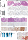 Figure 1. Increased glucose uptake and a change in PKM isoform expression accompanies Pten loss in mouse prostate tissue. A, Relative [18F]fluoro-2-deoxyglucose (FDG) uptake into the anterior prostate and gastrocnemius muscle of 7- to 11-week-old wild-type (WT) mice and mice with prostate-specific Pten deletion (Ptenpc–/–). Mean ± SD is shown (n = 6). The difference in FDG uptake between genotypes is significant in prostate (*, P < 0.05 by Student t test), but not in muscle. B, Representative H&E and IHC assessment of PKM1 and PKM2 expression in anterior prostate tissue harvested from WT mice of the indicated age. Adjacent seminal vesicle tissue is marked with *. Scale bar = 200 μm. C, Representative H&E and IHC assessment of PKM1 and PKM2 expression in prostate tissue harvested from Ptenpc–/– mice of the indicated age. Scale bar = 200 μm. D, Quantitation of PKM1 and PKM2 expression in prostate tissue harvested from Ptenpc–/– mice of the indicated age as determined by IHC. Tissue from 3 to 6 mice per age group was quantified. E, Representative IHC staining of PKM1 or PKM2 (brown), and PCNA (pink), in tumors from Ptenpc–/– mice of the indicated age. Scale bar = 200 μm.