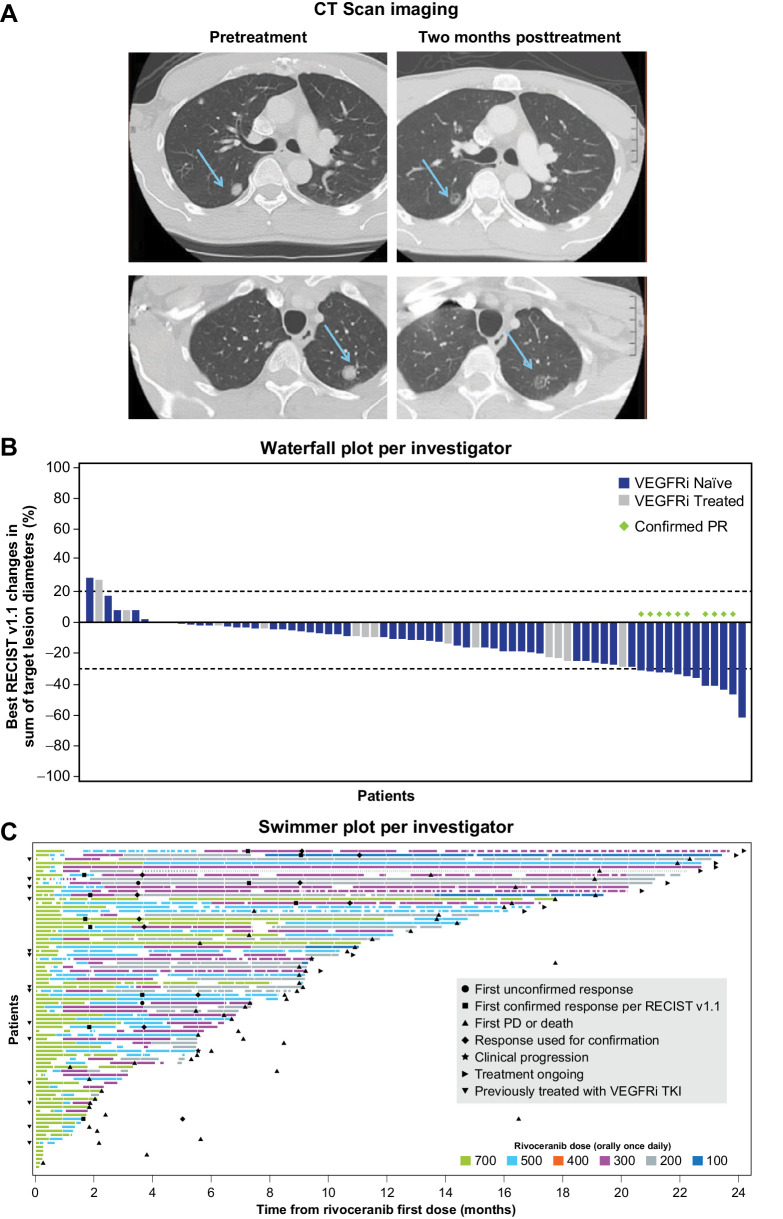 Figure 1. Imaging, waterfall plot, and swimmer plot depicting tumor responses assessed by investigator in the efficacy-evaluable population. A, CT scan images showing reduction in tumor lesion density without reduction in tumor lesion size 2 months after starting treatment with rivoceranib in a patient on study. B, Maximum change in sum of target lesions. Each bar represents one patient (n = 72). C, Duration of treatment in patients with confirmed response. Each bar represents one patient.