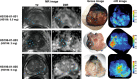 Figure 4. Preoperative MR images and ex vivo imaging of resected prostate tissue. Preoperative axial MR images of the prostate (T2-weighted and diffusion-weighted), gross images, and nIR images of resected prostate tissues analyzed by LI-COR Odyssey imager are shown. In MR images, T2-weighted and diffusion-weighted hypointense prostate cancer lesions are marked with asterisks at the center and blue arrow heads at the margin (left 2 columns). Resected prostate tissues were cut, and gross images and nIR images of cut surfaces, analyzed using LI-COR Odyssey 800 nm channel, are shown (right 2 columns). Prostate cancer lesions are marked with asterisks and arrow heads.