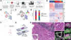 Figure 5. Single-cell RNA-seq and confocal microscopy of prostate cancer specimen. A, Process of sample preparation for single-cell RNA-seq of prostate cancer specimen. HS196+ and HS196− cell populations were isolated from enzymatically digested prostate specimen by flow-based sorting, and single-cell cDNA libraries were made and sequenced. B, EPCAM+ epithelial cells were reclustered and shown in UMAP plot. Six different clusters were identified. C, Cells in peripheral zone and in transition/central zone were identified based on gene expression of KLK3, KRT3, and SCGB1A1. Clusters 1 and 4 consist the peripheral zone, whereas other clusters are in the transition/central zone. D, Percentages of each cluster (clusters 1–6) in EPCAM+ cells in HS196+ and HS196− samples are shown. E, Expression of known prostate tumor markers by each cell/cluster is shown in the heatmap. Cells in the peripheral zone (clusters 1 and 4) are on the left side of the heatmap, and cells in the transition/central zone (clusters 2, 3, 5, and 6) are on the right side. AMACR expression is highlighted. F, HS196 positivity of AMACR+ prostate cancer cells (total 81 cells among 984 EPCAM+ cells) is shown. G, Serial frozen sections of the prostate specimen were used for H&E staining and RNA FISH. H&E pathology was coregistered with HS196 signal and an mRNA FISH image of AMACR. H, In the area of invasive prostate cancer, the presence of HS196-positive (magenta) and AMACR-expressing (green) prostate cancer cells was confirmed.
