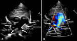 Pediatric echocardiogram of partial anomalous left pulmonary artery (PALPA) in
a 4-month-old patient. (A) Grayscale and (B) color Doppler images demonstrate a
second left pulmonary artery (LPA) (the PALPA) arising from the right pulmonary
artery (RPA). Color aliasing is noted at the stenotic lower RPA. AO = aorta, MPA =
main pulmonary artery.
