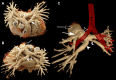 (A, B) Contrast-enhanced CT angiographic chest three-dimensional
volume-rendered images obtained using cinematic rendering in the (A) anterosuperior
and (B) posterosuperior views. The main pulmonary artery trunk (black arrow)
bifurcation gives rise to the left upper lobe pulmonary artery (white arrow) and
right pulmonary artery (RPA) (black arrowhead). The stenotic lower RPA is again
demonstrated (curved white arrow). The partial anomalous left pulmonary artery
(PALPA) (white arrowhead) is seen arising from the RPA. (C) Three-dimensional
volume-rendered image of the pulmonary arteries with superimposed airways
demonstrates the PALPA coursing posterior to the left mainstem bronchus (LB). RB =
right mainstem bronchus, T = trachea.