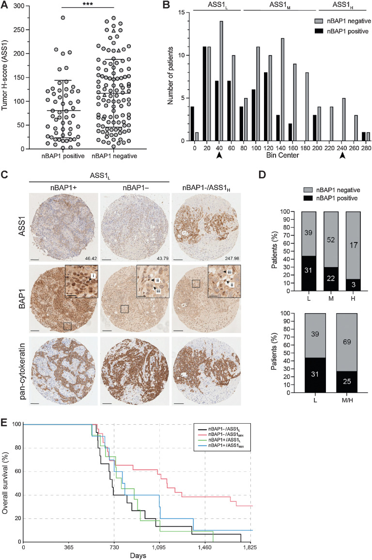 Figure 5. ASS1 protein levels are elevated in epithelioid MPM samples with loss of nBAP1. nBAP1 staining was scored as positive (n = 56) or negative (n = 108) by three independent observers, and mean ASS1 tumor H-scores digitally determined for 164 epithelioid samples (2 to 4 cores per patient). A, ASS1 expression is higher in epithelioid MPM without nBAP1; bars indicate mean and 1 SD; Mann–Whitney test, ***, P = 0.001. B, Frequency distribution of ASS1 tumor H-scores defines three groups: ASS1L (low ASS1, tumor H-score <80); ASS1M (moderate ASS1, tumor H-score ≥80–200); ASS1H (high ASS1, tumor H-score ≥200). C, Images of MPM cores representing the mid-point of the ASS1L and ASS1H groups (indicated by arrow heads in B). The tumor H-score for ASS1 is shown; magnified insets indicate (i) nBAP1-positive tumor cells, (ii) nBAP1-positive stromal cells, (iii) nBAP1-negative tumor cells. Scale bars, 100 or 20 μm in insets. D, Loss of nBAP1 is more frequent in groups with higher ASS1 expression. Comparison of the three ASS1 groups χ2 test, ***, P < 0.0001 (top); and ASS1 L group compared to the combined ASS1M/H groups, Fisher exact test, *, P = 0.018 (below). The numbers of nBAP1-positive or nBAP1-negative patients in each group are indicated. E, Improved survival of patients with nBAP1-negative ASS1M/H tumors. Kaplan–Meier curve is shown at 18-month landmark. Cox model: nBAP1-negative ASS1M/H (n = 26) versus ASS1L (n = 15) P = 0.003; nBAP1-positive ASS1M/H (n = 10) versus ASS1L (n = 11) P = 0.383; supporting data in Supplementary Table S5 and Supplementary Fig. S13.