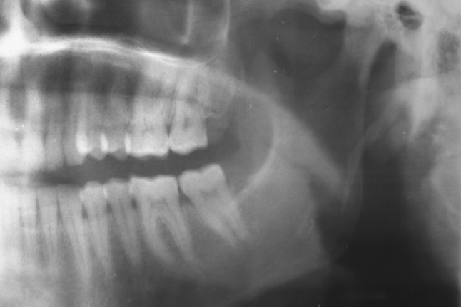 Eagle’s Syndrome: A New Surgical Technique for Styloidectomy - PMC