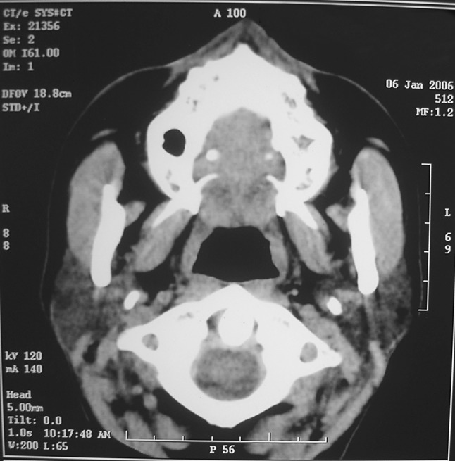 Eagle’s Syndrome: A New Surgical Technique for Styloidectomy - PMC