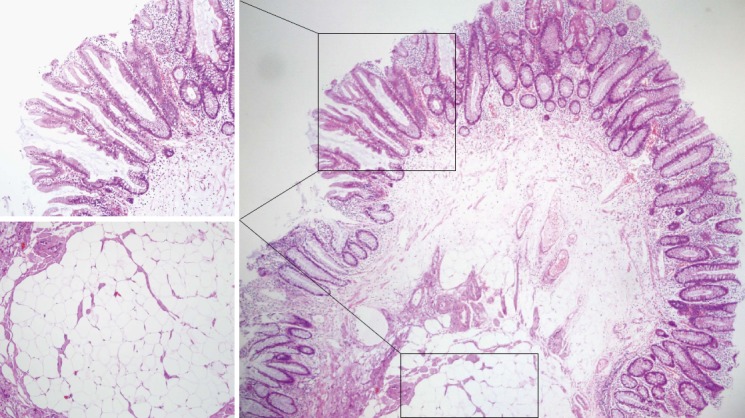 Colonic lipoma covered by hyperplastic epithelium: Case report - PMC