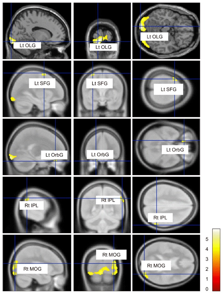 Effects Of Amisulpride Adjunctive Therapy On Working Memory And Brain 