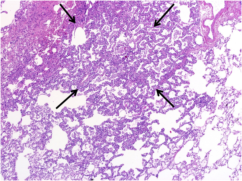 Multifocal micronodular pneumocyte hyperplasia (MMPH) in a patient with ...