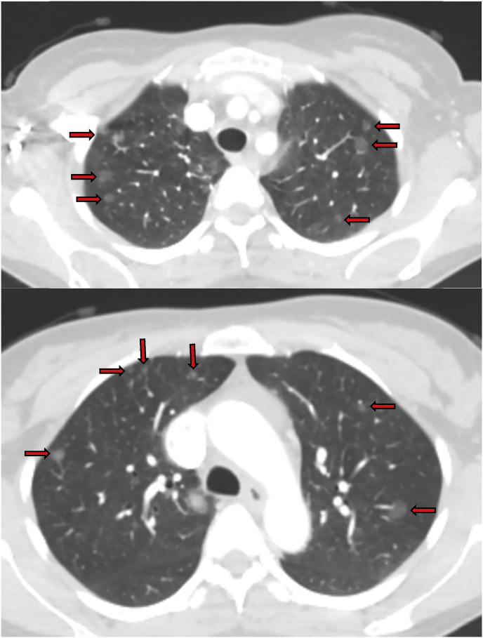 Multifocal micronodular pneumocyte hyperplasia (MMPH) in a patient with ...