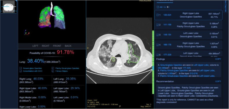 The Brazilian COVID-19 Chest CT Database. There are 47 hospitals connected from different Brazilian states to the central database. Almost 20,000 chest CT’s have been analyzed to date, with a COVID-19 prevalence of 75%. This high prevalence is in part a reflection of increased cases submitted for analysis from dedicated COVID-19 and reference hospitals. The results screen shows example images, the probability of COVID-19 and the percent of lung parenchyma involvement. Such automated analysis can aid in direct patient management, as well as be potentially utilized for studies evaluating the efficacy of therapeutic interventions.