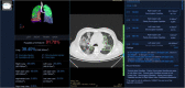 The Brazilian COVID-19 Chest CT Database. There are 47 hospitals connected from different Brazilian states to the central database. Almost 20,000 chest CT’s have been analyzed to date, with a COVID-19 prevalence of 75%. This high prevalence is in part a reflection of increased cases submitted for analysis from dedicated COVID-19 and reference hospitals. The results screen shows example images, the probability of COVID-19 and the percent of lung parenchyma involvement. Such automated analysis can aid in direct patient management, as well as be potentially utilized for studies evaluating the efficacy of therapeutic interventions.