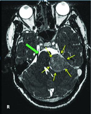 MRI 3D CISS– A Novel Imaging Modality in Diagnosing Trigeminal ...