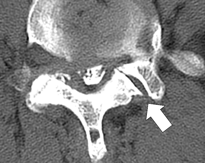 Risk Factors For Reoperation At Same Level After Decompression Surgery For Lumbar Spinal