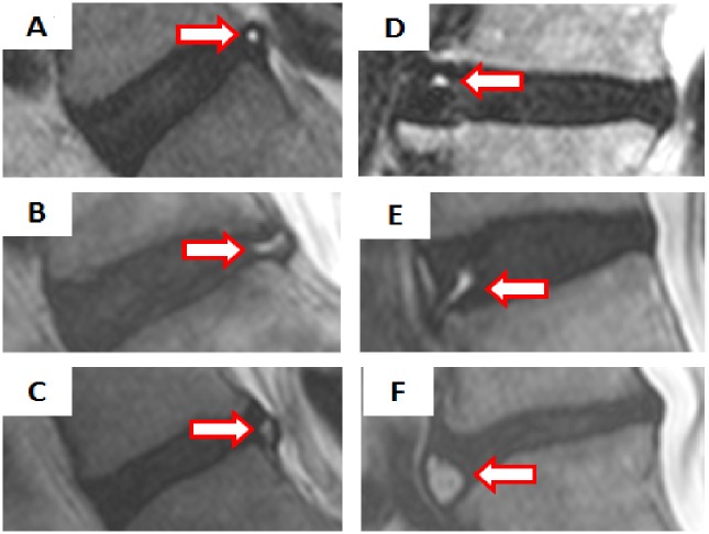 Classification of High Intensity Zones of the Lumbar Spine and Their ...