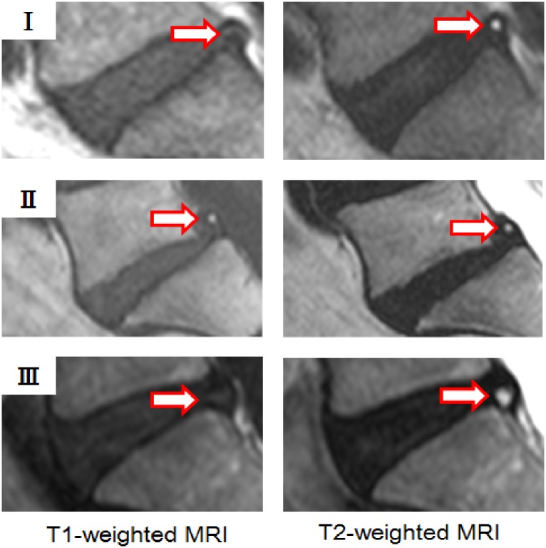 Classification of High Intensity Zones of the Lumbar Spine and Their ...