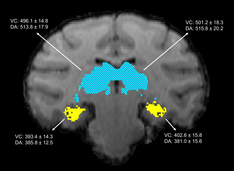 Figure 3 is a hippocampus and magnetic resonance image, depicting the coronal section in the brain of an animal with the transformed macaque atlas overlayed in the same space.