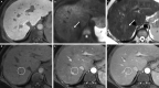 MRI scans with gadoxetate in a 57-year-old woman with hepatitis C
virus cirrhosis. MRI scans demonstrate (A) a 10-mm observation (arrow) with
hepatobiliary phase hypointensity, (B) mild diffusion restriction (arrow)
with diffusion-weighted image with b = 800 m/sec2, and (C) mild
T2-hyperintensity (arrow) with lesional fat sparing (not shown). The
observation is not discernable on (D) precontrast T1-weighted image, (E)
arterial phase, or (F) portal venous phase (the region of the observation is
marked by a circle in D–F). The observation progressed to LR-5
(definite hepatocellular carcinoma) in 2 years.