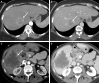 CT images show examples of observations that meet criteria for Liver
Imaging Reporting and Data System (LI-RADS) category LR-M (probably or
definitely malignant, not hepatocellular carcinoma [HCC] specific). Axial
contrast-enhanced CT in (A) arterial phase and (B) portal venous phase in a
56-year-old woman with nonalcoholic steatohepatitis-induced cirrhosis
demonstrates a 36-mm observation (arrow, B) with rim arterial phase
hyperenhancement (arrow, A). Pathology revealed intrahepatic
cholangiocarcinoma. Axial contrast-enhanced CT in (C) arterial phase and (D)
portal venous phase in a 63-year-old man with hepatitis C virus cirrhosis
demonstrates a 90-mm observation (arrow, D) with rim arterial phase
hyperenhancement (arrow, C). Pathology revealed poorly differentiated HCC
with p53 mutation.