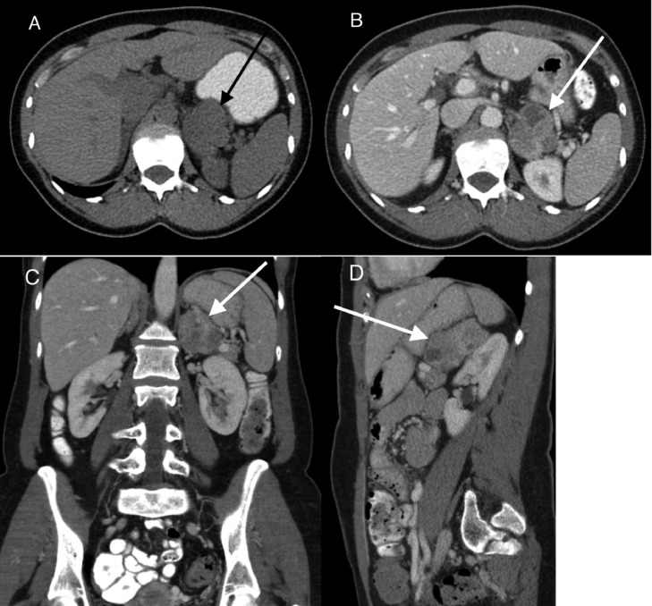 Primary adrenal leiomyosarcoma pmc
