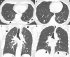 Distribution of interstitial lung abnormalities (ILAs). (A) ILA with subpleural predominance. Axial CT scan shows reticulation and ground-glass abnormality (arrowheads) in bilateral subpleural area. (B) ILA with central predominance. Axial CT scan shows patchy ground-glass abnormalities (arrowheads) in central area of left lower lobe. Nodular ground-glass abnormalities (arrow) are also seen in central area of right lower lobe. (C) ILA with upper-lobe predominance. Coronal CT scan shows subpleural reticulation and ground-glass abnormality (arrows) in both upper lobes. (D) ILA with lower-lobe, or basal, predominance. Coronal CT scan shows subpleural ground-glass abnormality (arrows) and nonemphysematous cyst in bilateral basal area.