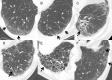 Thin-section CT scans show typical findings of interstitial lung abnormalities. (A) Ground-glass abnormality (arrows) is seen in peripheral lung zone. (B) Reticular abnormality with ground-glass opacity (arrows) is seen in subpleural area. (C) Lung distortion is suggested by volume loss and displacement of bronchi and vessels toward medial side (arrow). Distortion accompanies ground-glass abnormality and traction bronchiectasis. (D) Traction bronchiectasis (arrow) is conspicuous in left lower lobe. Ground-glass and reticular abnormalities are also seen in subpleural area. (E) Honeycombing is demonstrated as appearance of clustered cystic air spaces (arrow). (F) Nonemphysematous cysts can be seen as lucencies with well-defined walls (arrows). Surrounding ground-glass and reticular abnormalities are also seen.