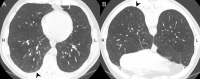 Dependent abnormality. L = left. (A) Supine CT scan shows faint ground-glass abnormality (arrowhead) in dependent portion of right (R) lower lobe. (B) Abnormality disappeared (arrowhead) in same area on prone CT scan, indicating abnormality on A was atelectasis and not interstitial lung abnormality.