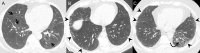 Typical interstitial lung abnormalities (ILAs). (A) Nonsubpleural and nonfibrotic ILA. CT scan shows multifocal ground-glass abnormalities (arrows) in central area of both lungs. (B) Subpleural nonfibrotic ILA. CT scan shows predominantly subpleural ground-glass and linear abnormalities (arrowheads) without evidence of fibrosis. (C) Subpleural fibrotic ILA. Besides subpleural ground-glass and linear abnormalities (arrowheads), CT scan shows traction bronchiectasis (arrow) and architectural distortion in left lower lobe, which suggests lung fibrosis.