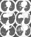 Progression of interstitial lung abnormalities (ILAs) in three individuals (A and B, C and D, and E and F). A, C, and, E are CT scans obtained 5 years before B, D, and F, respectively, in each individual. (A) Scan shows no evidence of ILA. (B) Scan shows newly developed ground-glass abnormalities (arrows) in subpleural area of bilateral lungs. (C) Scan shows slight ground-glass abnormality and nonemphysematous cysts (arrows) but no clear evidence of fibrosis. (D) Scan shows increased severity and extent of abnormalities (straight arrows) with new traction bronchiectasis indicating lung fibrosis (curved arrow). (E) Scan shows mild unilateral ground-glass abnormalities (arrows) suggesting ILAs. (F) Individual developed severe architectural distortion with traction bronchiectasis in both lower lobes (circles).