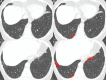 Use of data-driven texture analysis to quantify progression of interstitial lung abnormality (ILA) in Genetic Epidemiology of Chronic Obstructive Pulmonary Disease Study patient. (A) Baseline CT scan shows minimal ILA. (B) CT scan with data-driven texture analysis overlay precisely identifies fibrotic abnormality, quantified as 1.4% of lung volume. (C) CT scan obtained 5 years later shows clear disease progression. (D) Follow-up CT scan with data-driven texture analysis overlay shows extent of ILA progression, quantified as 5.6% of lung volume. (Figure 8 courtesy of Stephen M. Humphries, PhD, Quantitative Imaging Laboratory, National Jewish Health.)
