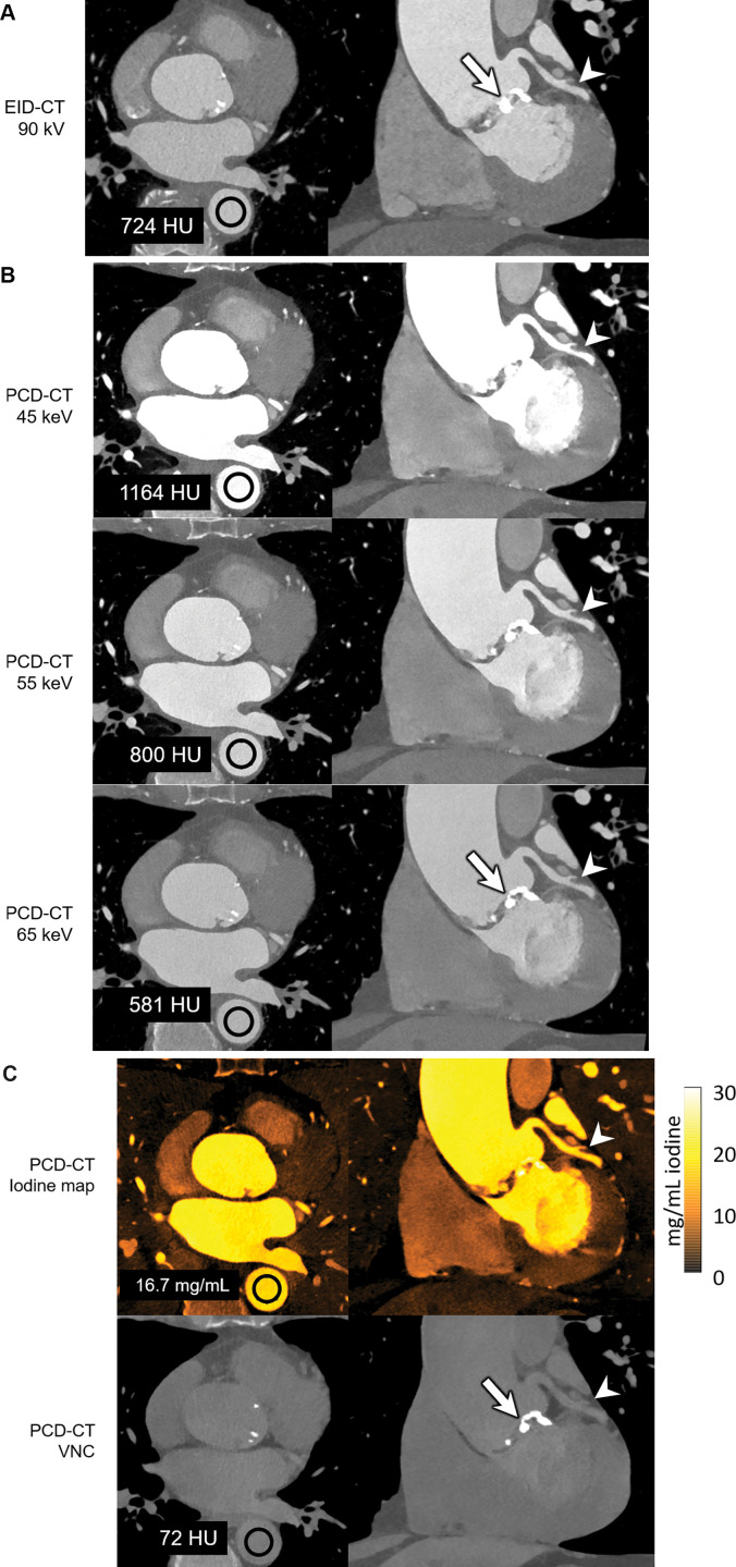 Images in a 71-year-old man scanned with(A) energy-integrating detector (EID) CT and (B, C) photon-counting detector (PCD) CT with dual-source geometry to achieve 66-msec temporal resolution. Axial images are shown in left column, and oblique coronal images are shown in right column. While the EID CT examination is limited to single-energy data (A) at this temporal resolution, the multienergy capabilities of the PCD CT system allowed creation of low-energy (45, 55 keV) virtual monoenergetic images (VMIs) (B), which showed increased iodine signal (shown as mean Hounsfield unit measurements in regions of interest) compared with EID CT despite an 18% decrease (A: 110 mL vs B, C: 90 mL iohexol [Omnipaque 350, GE Healthcare]) in volume of administered contrast material (mean CT numbers for the black circular regions of interest are given in the left column of images). The use of VMIs adds to the inherently higher iodine contrast-to-noise ratio possible with PCD CT and provides clearer delineation of a branch of the left coronary artery (arrowheads). Increasing the VMI energy (65 keV or higher) decreased calcium blooming relative to EID CT (arrows in A and B). Absolute iodine concentration was measured using the iodine map images (mean concentration in mg/cm3 unit shown in region of interest) and virtual noncontrast (VNC) images used to visualize calcifications (arrow in C) with attenuation similar to that of iodinated blood. Reconstruction kernels used were as follows: Bv40 (body-vascular, sharpness level 40) (EID CT 90-kV, in A), Bv48 (PCD CT VMIs in B), Qr40 (quantitative-regular, sharpness level 40) (PCD CT iodine map and VNC images in C) Display windows and levels were as follows: 2000 HU and 200 HU for EID CT and PCD CT VMIs, 30/15 mg · mL−1 for iodine map, and 1000 HU and 100 HU for VNC image.