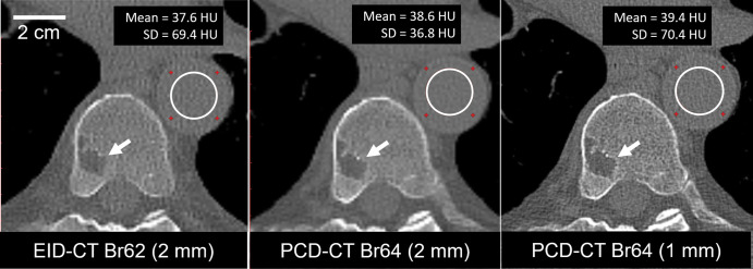 Axial images in a 74-year-old man clinically indicated for whole-body low-dose CT skeletal survey for multiple myeloma. Energy-integrating detector (EID) CT scan (left) and high-spatial-resolution photon-counting detector (PCD) CT scans (center and right) were acquired using the same radiation dose (4.2 mGy). PCD CT image (center) using same section thickness (2 mm) as EID CT image (left) showed 47% lower noise (36.8 HU vs 69.4 HU within the white circular regions of interest). Use of thinner (1-mm) section thickness (right) and 1024 × 1024 matrix resulted in image noise similar to that of the EID CT image and improved delineation of vertebral lesion (arrows). Display window = 1500 HU; display level = 150 HU. Br = body-regular reconstruction kernel, SD = standard deviation of pixel values in region of interest.