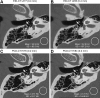 Oblique axial images in a 72-year-old man scanned with (A, B) energy-integrating detector (EID) CT and (C, D) photon-counting detector (PCD) CT for temporal bone examination. Right temporal bone images acquired with use of EID CT were reconstructed using ultra-high-resolution-regular (Ur) kernels (Ur77 and Ur85) at 0.4-mm section thickness and PCD CT using head-regular (Hr) kernels (Hr76 and Hr84) at 0.2-mm section thickness. PCD CT images show better trabecular detail and delineation of the stapes (arrows) compared with EID CT (images C and D vs A and B), despite use of 30% lower dose (32.6 mGy vs 46.4 mGy) for PCD CT. Display window = 3800 HU; display level = 700 HU. Mean and standard deviation (SD) of CT numbers were measured in the white circular regions of interest.