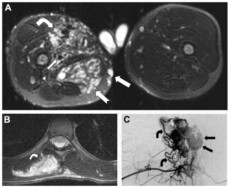 PTEN Hamartoma of Soft Tissue: A Distinctive Lesion in PTEN Syndromes - PMC