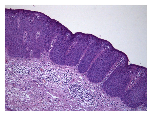 A Clinical and Pathological Overview of Vulvar Condyloma Acuminatum ...