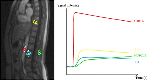 MRI in multiple myeloma: a pictorial review of diagnostic and post ...