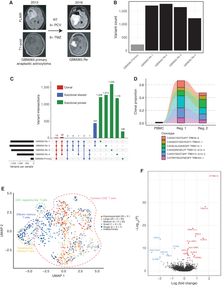 Figure 6. Immunogenomic profile of hypermutated recurrent GBM. A, Description of clinical course. RT, radiation therapy; PCV, procarbazine, CCNU, and vincristine; TMZ, temozolomide. B, Total variants identified from WES for primary tumor and each analyzed region of recurrence. C, UpSet plot of the distribution of all identified variants grouped by the set of tumor samples in which a variant is shared. D, Alluvial plot displaying the frequency of the five most expanded intratumoral TCR β-chain sequences from either region of recurrent tumor across peripheral blood and tumor samples. E, UMAP dimensionality reduction of the scRNA-seq data of T cells from GBM065.Re. The dashed outline delineates the general population each cell belongs to and the color indicates the degree of expansion for that T-cell clone (defined by α/β pair). F, Volcano plot of differentially expressed genes within hyperexpanded clones relative to rest of T cells.