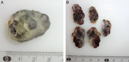 Primary anorectal melanoma mimicking polyp in a scleroderma patient: a ...