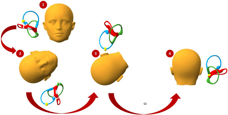 Universal Repositioning Maneuver: A New Treatment for Single Canal and ...