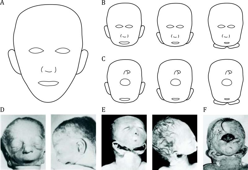 Holoprosencephaly and Agnathia Spectrum: Presentation of Two New ...