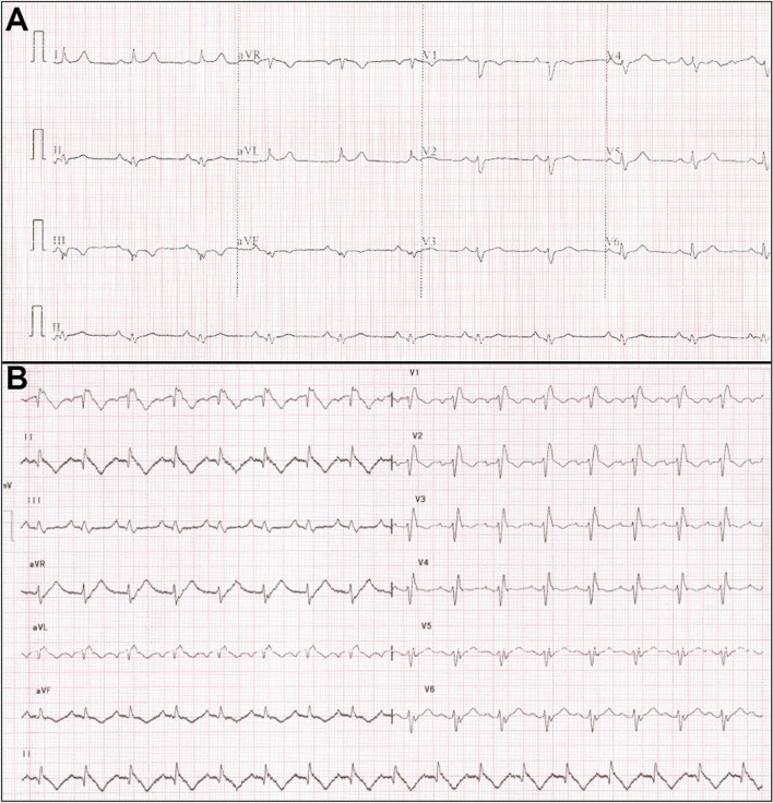 Ebstein’s anomaly: an electrophysiological perspective - PMC