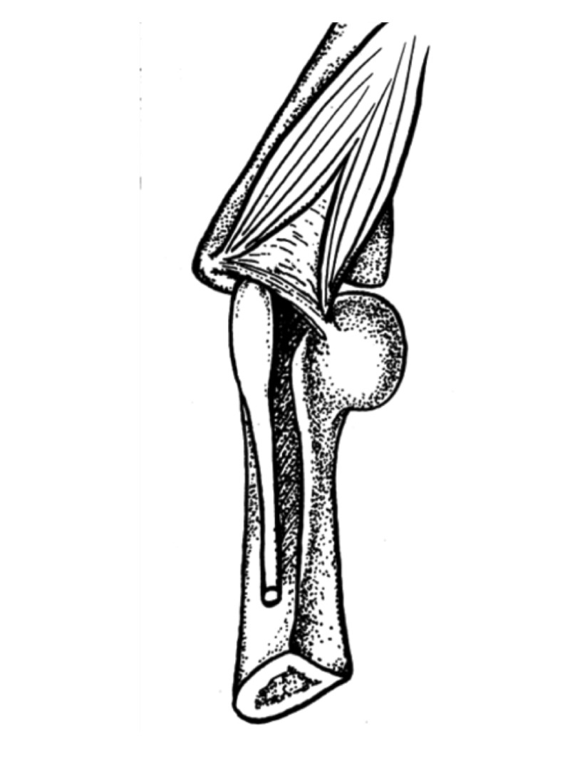 Osborne’s Ligament: A Review of its History, Anatomy, and Surgical ...