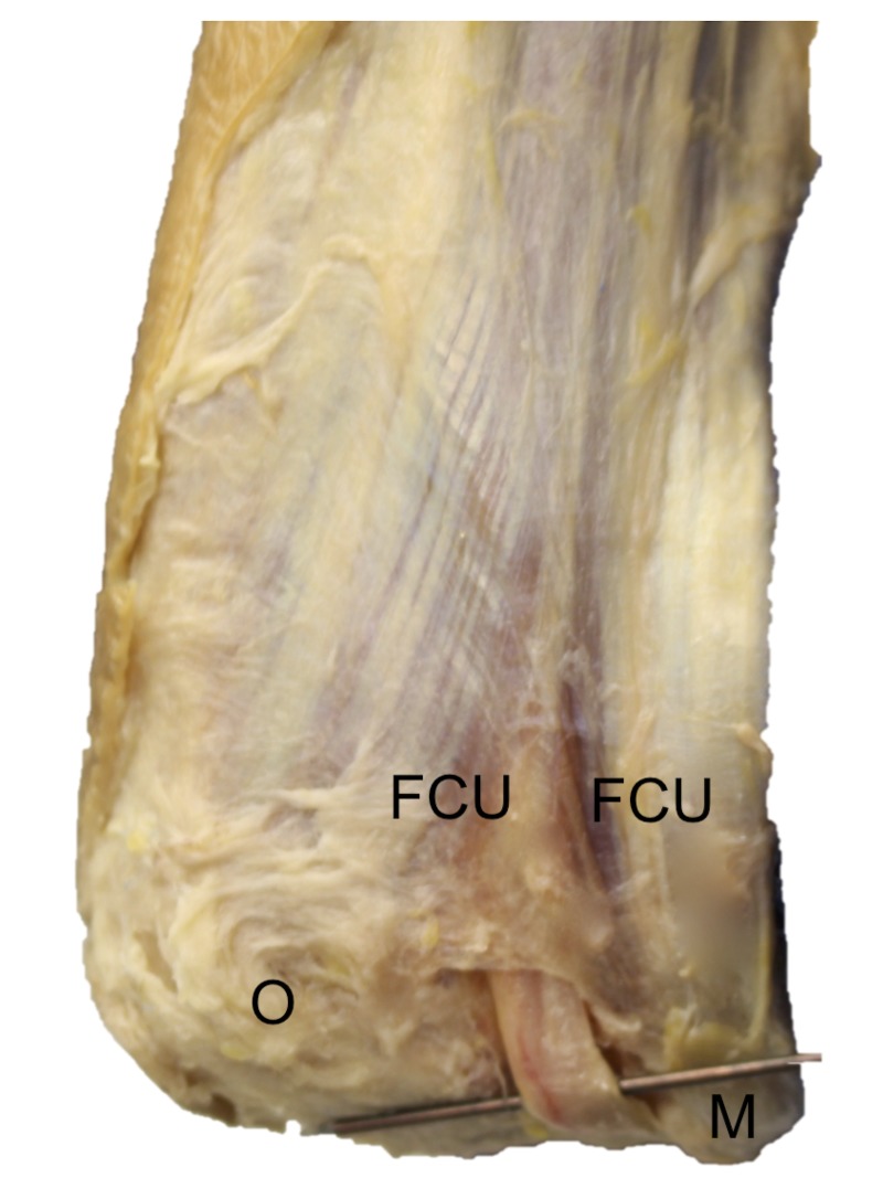 Osborne’s Ligament: A Review of its History, Anatomy, and Surgical ...