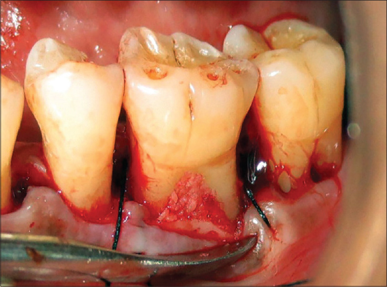 A novel approach in the management of mandibular degree II furcation ...