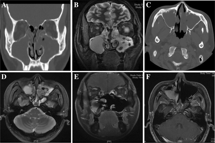 Intranasal Endoscopic Prelacrimal Recess Approach For Maxillary Sinus