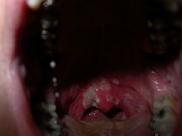 Uvulitis following general anaesthesia - PMC